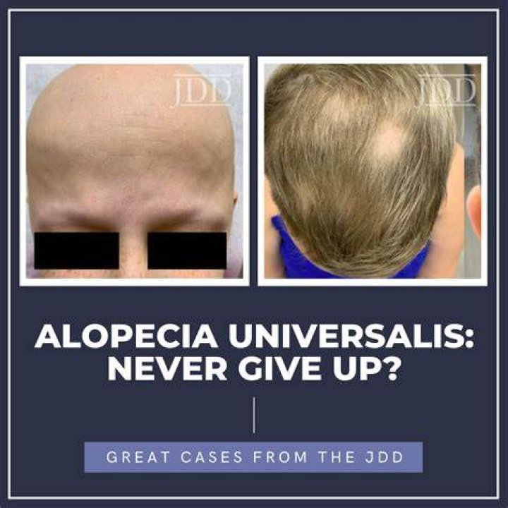 alopecia Archives - 247 News Around The World