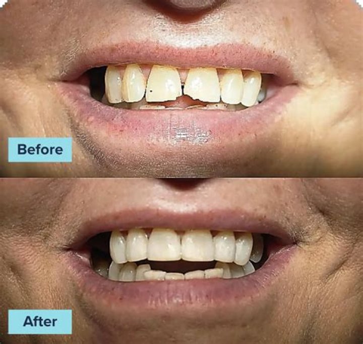 Before: Composite bonding is usually used for filling chips, fractures or gaps between teeth or for fixing discolouration (pictured before)