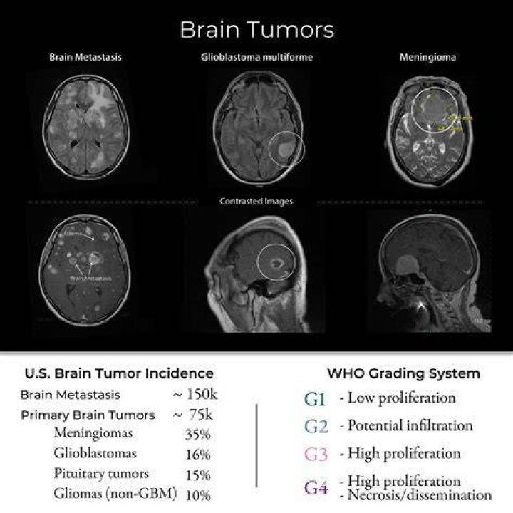 brain tumors Archives - 247 News Around The World