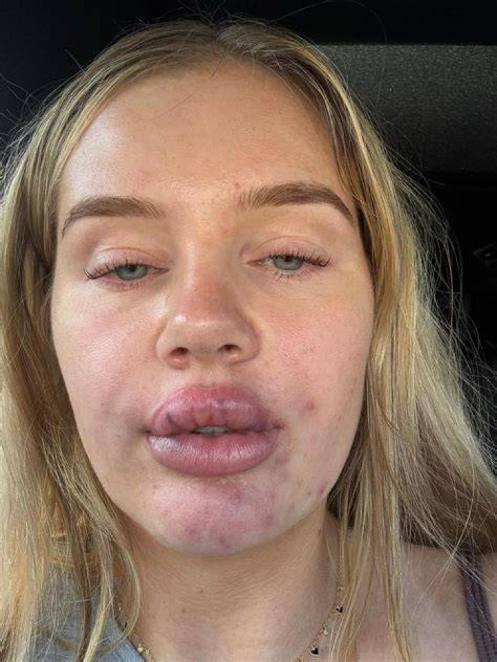 Change: Molly-Mae also got her lip fillers dissolved late last year and later told her fans on social media that she had been considering getting rid of her it for six months prior