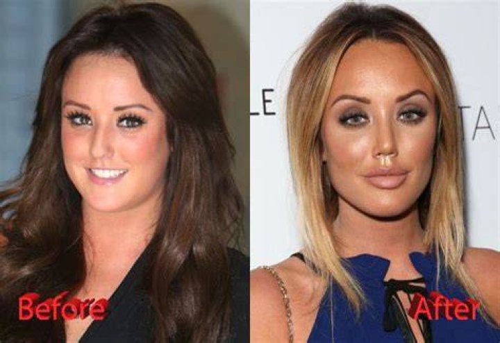 Charlotte Crosby surgery - Before and After