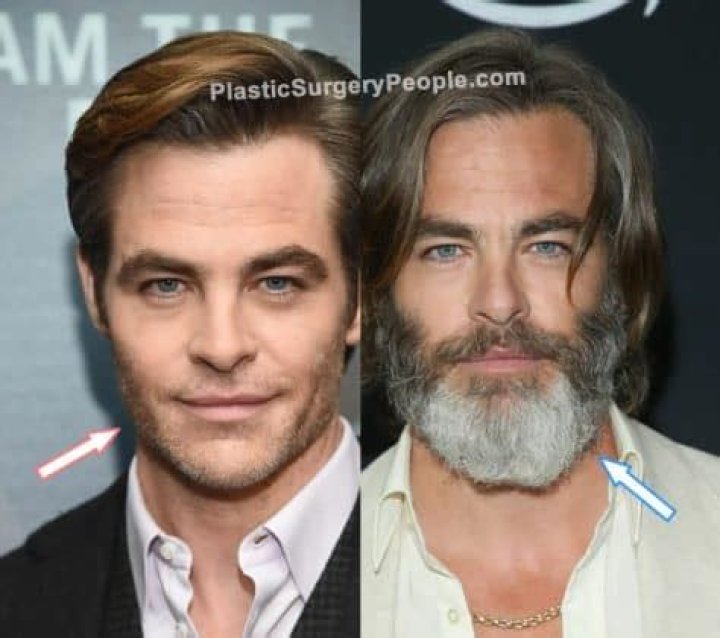 Did Chris Pine Get Plastic Surgery? Who is Chris Pine?