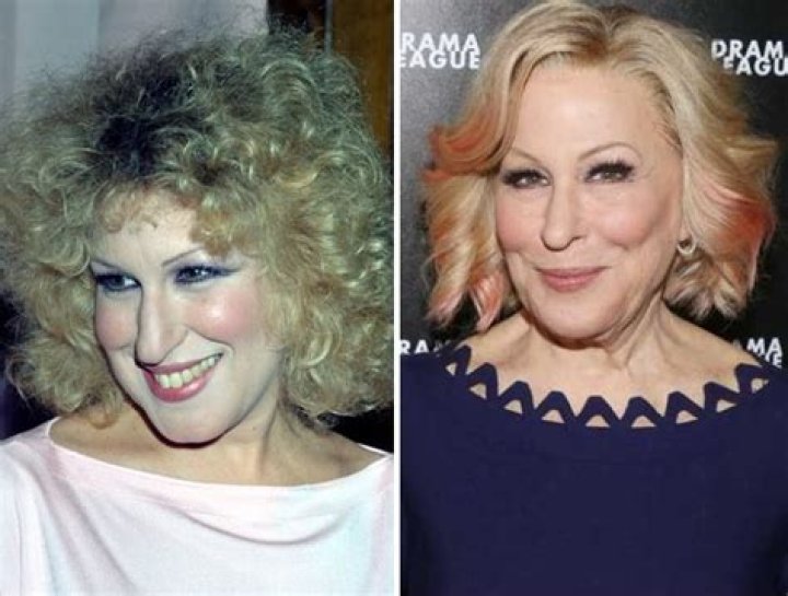 Does Bette Midler Had Nose Job And Botox Plastic Surgery?