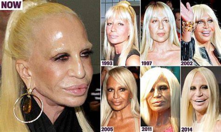 Donatella Versace Plastic Surgery Gone Wrong January 2024