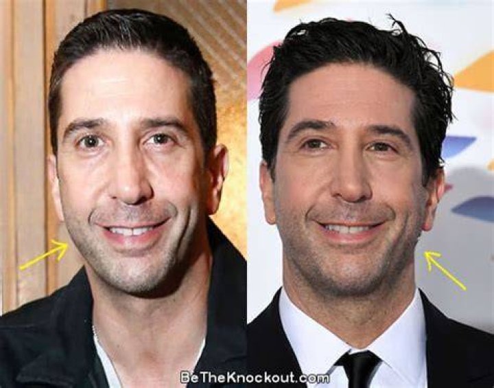 Has David Schwimmer had Plastic Surgery? Who is David Schwimmer?