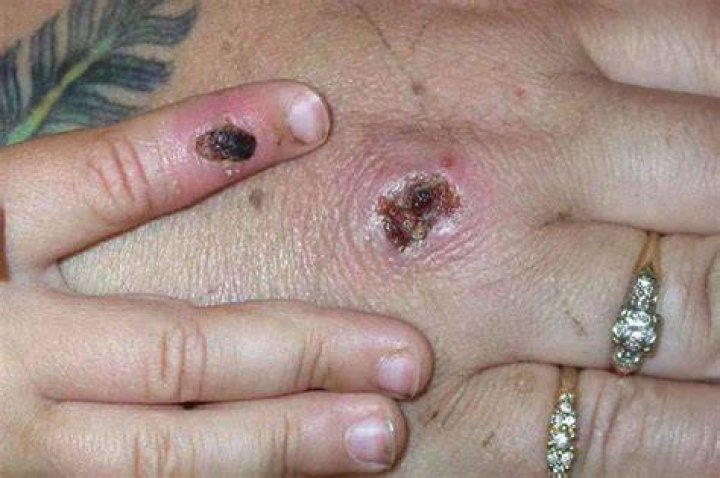 Monkeypox cases in Yorkshire confirmed by health officials