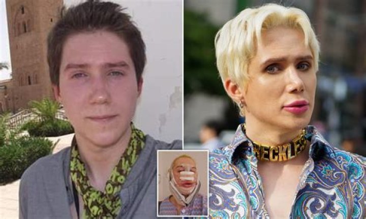 Ollie London Plastic Surgery Before and After