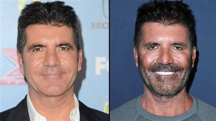 Simon Cowell PLsatic Surgery Before and After
