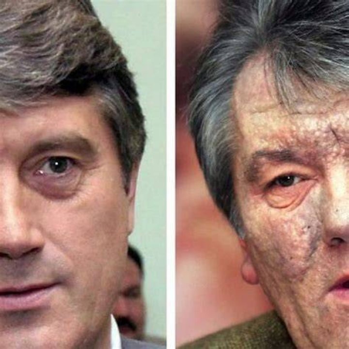 Viktor Yushchenko Face Before And After, Former President Was Poisoned By An Agent