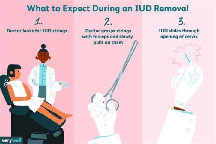 What To Expect During IUD Removal, According to.OB/GYNs